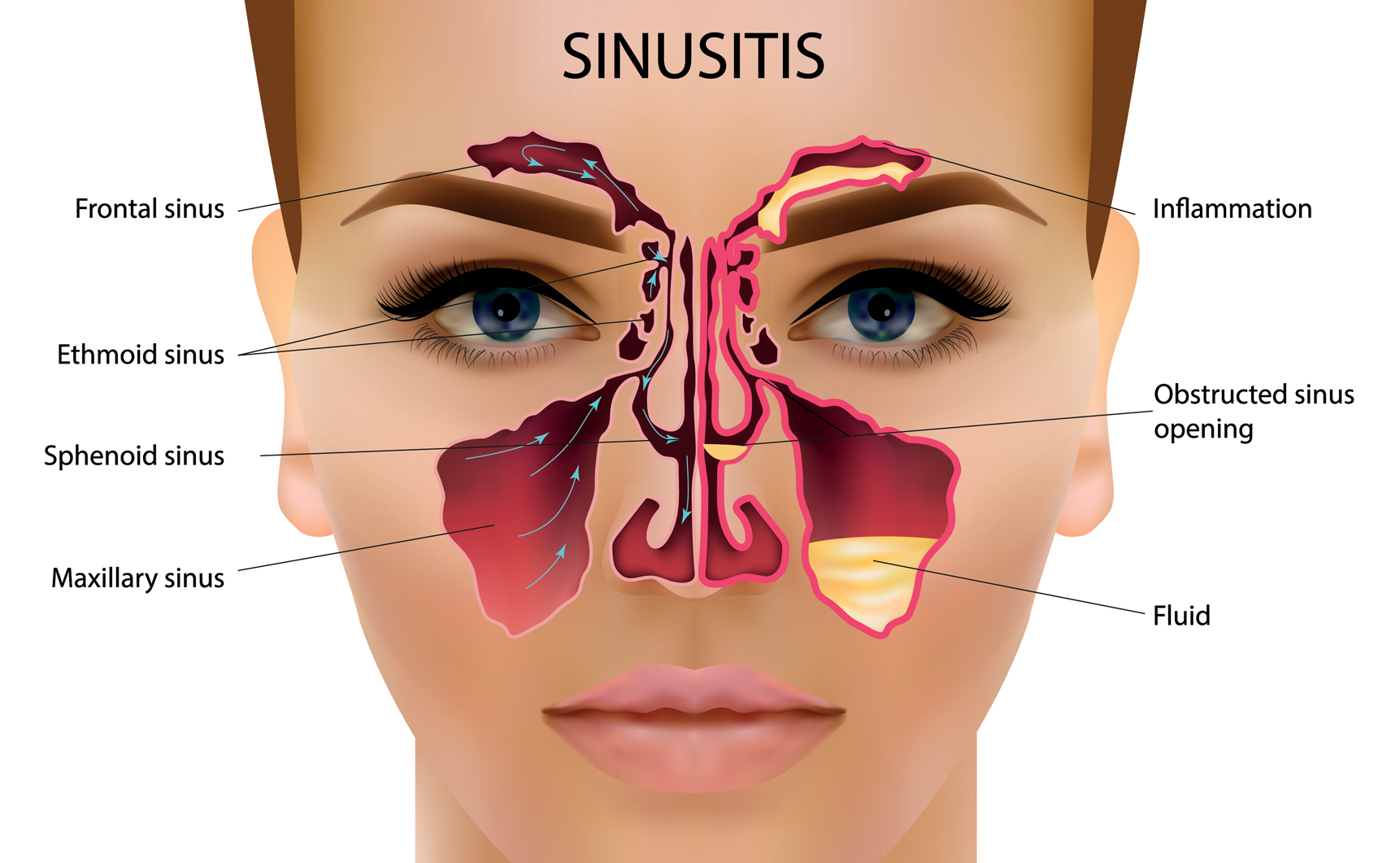 Young woman with sinus pressure pain