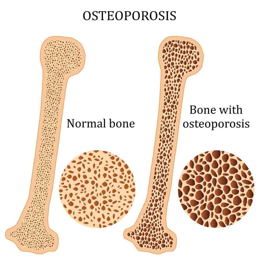 osteoporoza